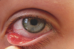  Как да се отървем от ечемика на окото