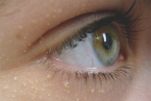  Как да се отървете от Уен под очите