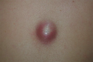  Как да се отървете от атерома