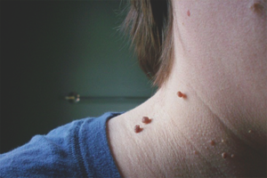  Как да се отървете от папиломи на шията