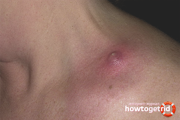 Защо се появи чире?