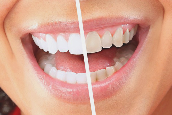 Как да се отървете от плаката на зъбите