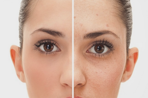  Как да се отървете от акне за 1 ден