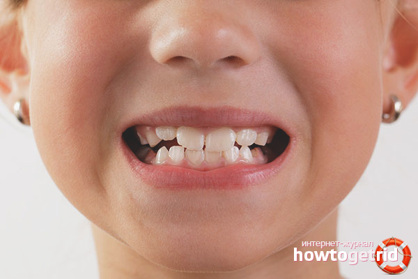 Как да подсилим бебешките зъби при дете