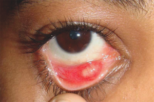  Как да се третира ечемика в очите на детето