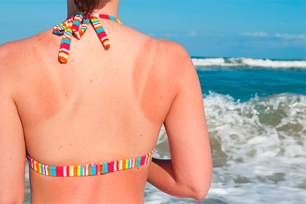 Was tun, wenn in der Sonne stark verbrannt wird?