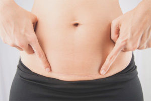  Как да обработим косата след цезарово сечение