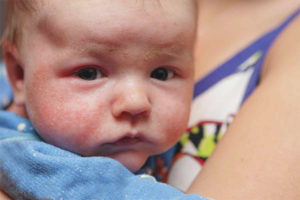  Диатезата по бузите на детето