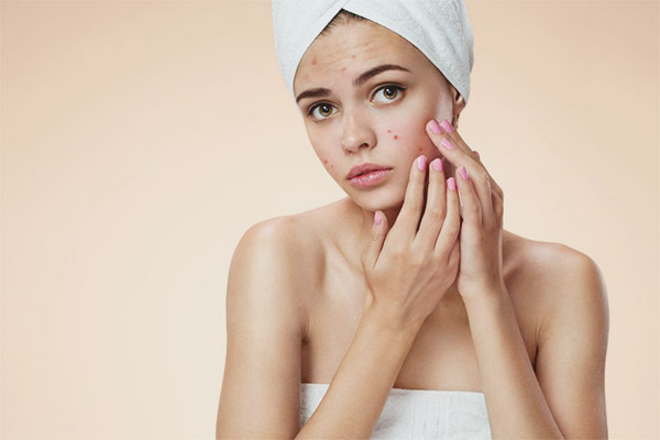 Hormonelle Akne bei Frauen