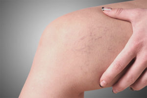  Паяк вени по краката