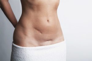  Плюсове и минуси цезарово сечение