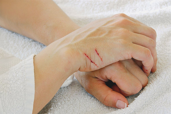 Как да се справяте с драскотини от котка