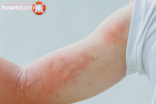 Алергия за чай